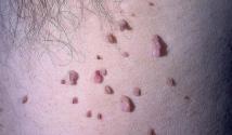 Маленькие папилломы на теле: причины возникновения и методы лечения