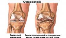Причины, симптомы и лечение остеоартроза суставов